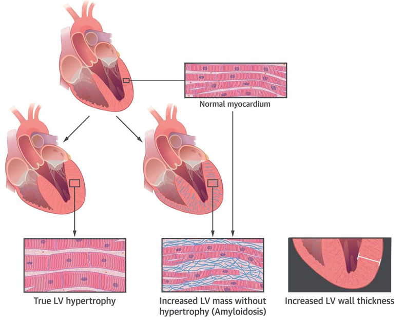 L’AMILOIDOSI CARDIACA. 2. FISIOPATOLOGIA Centro Grossi Paoletti